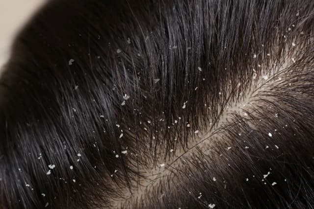 Dandruff?